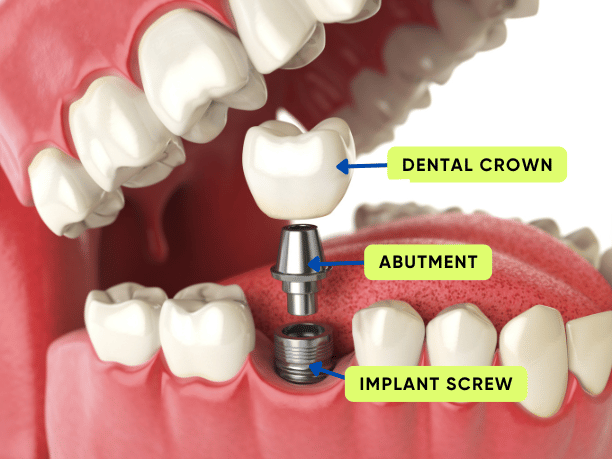 Dental Implants - Elite Dental Group